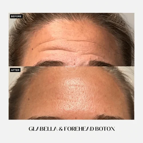 Botox1