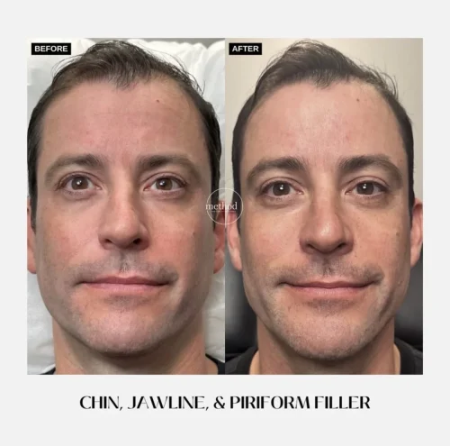 Fillers1
