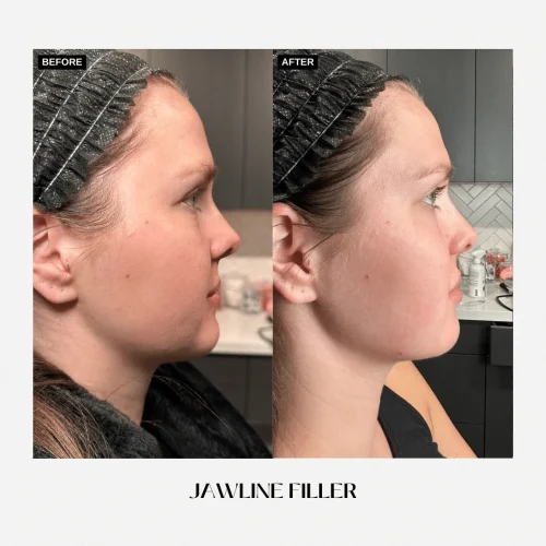 Fillers2