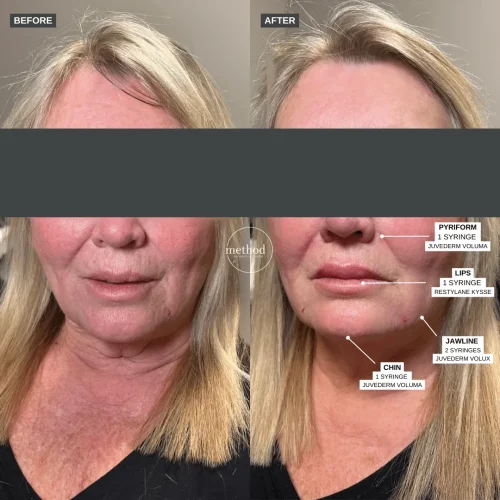 Fillers3
