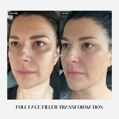 Fillers4